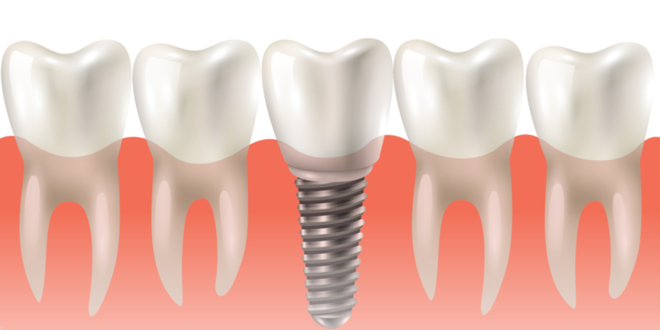 Implant dentaire